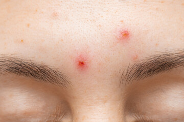 Skin of face of young woman is affected by chickenpox, acne defects
