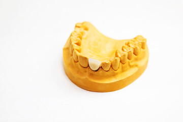 Dental implant. Jaw model with an artificial tooth