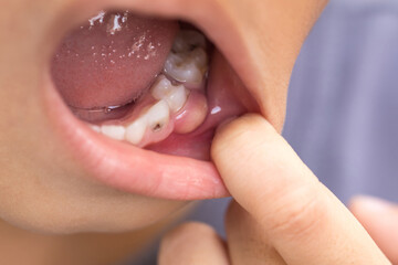 Asian little boy with decayed teeth with smiling