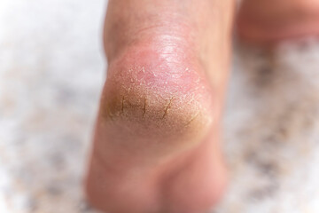 The heel of foot with bad skin is covered with cracks. The concept using medical treatment with moisturizers and also vedekure and peeling of wound healing and pain while walking swatch dermatologist