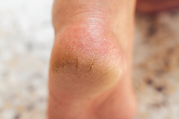 The heel of foot with bad skin is covered with cracks. The concept using medical treatment with moisturizers and also vedekure and peeling of wound healing and pain while walking swatch dermatologist