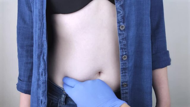 A woman suffers from pain in the appendix. Acute appendicitis, Crohn's disease, or inflammatory bowel disease. Surgeon examination and preparation for laparoscopic appendectomy