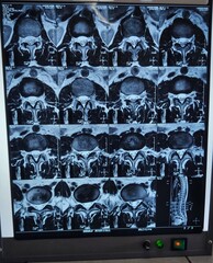 CT scan Section of a lumbar vertebrae 