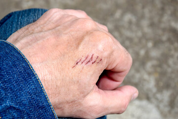 Close-up of man's hand with saw wound. Fresh scars on the skin with traces of clotted blood. Selective focus.