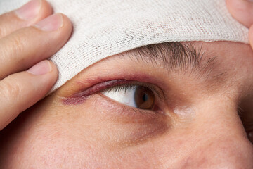 close view of a black eye, man's face with a hematoma