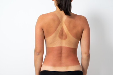 naked female back with sunburn and traces of a swimsuit. on white.