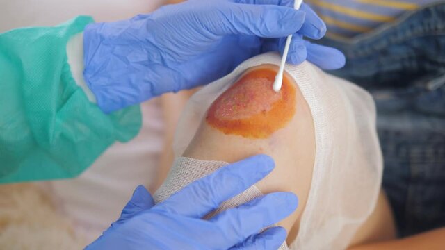 Close-up, a doctor in medical sterile gloves cotton swab treated with antiseptic bleeding wound on the knee of a teenage girl.