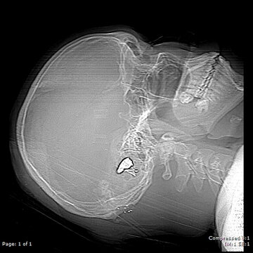 X-Ray Bullet Fragmentation In Brain Male 20 Year Old