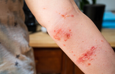 painful poison ivy rash and blisters