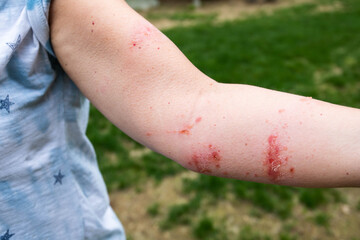 poison oak and poison ivy rash reaction, painful blisters and itchiness