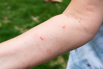 poison ivy spreading on woman's arm, bumps and blisters