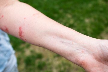 Poison ivy rash and reaction