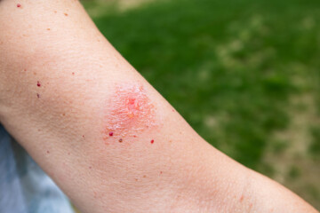 Oozing poison ivy blisters on arm