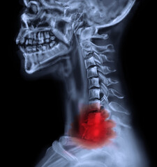 X-ray of patient with cancer. Illustration