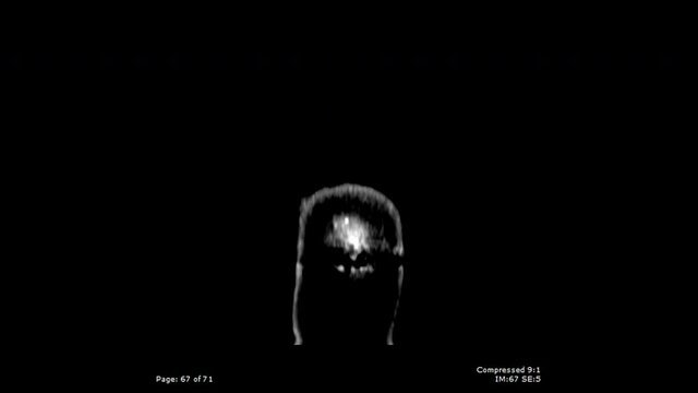 CT scan a coronal view with bullet fragmentation in brain male 20-year-old