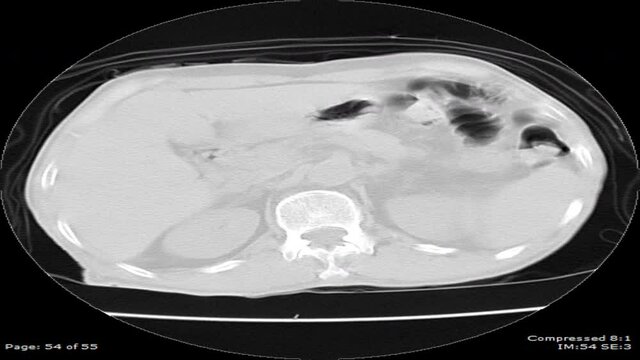  CT chest lung Axial view Male 77-year-old abscess lung with pneumonia