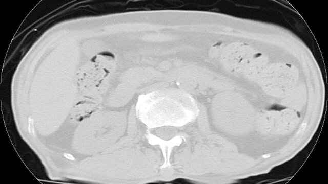  CT chest lung Axial view Male 77-year-old abscess lung with pneumonia