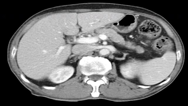 CT chest lung axial view with contrast Male 77year old after treatment abscess lung with pneumonia
