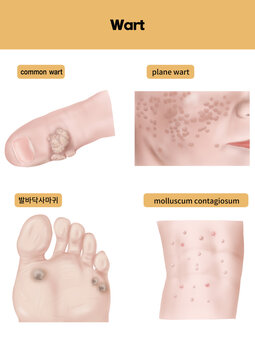 사마귀 설명을 위한 메디컬일러스트