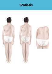 척추측만증 설명을 위한 메디컬일러스트