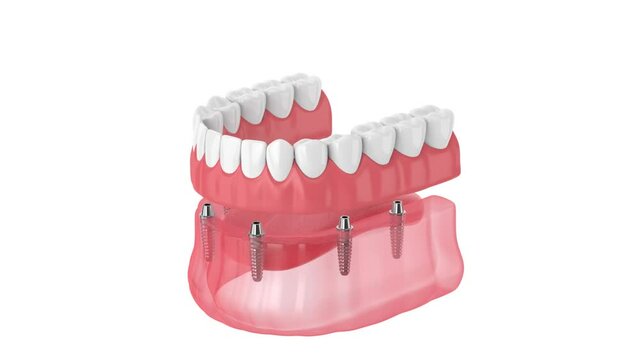 Removable full implant denture isolated over white background