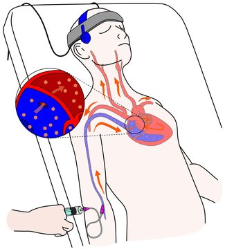 Transcranial Doppler Sonography With Bubble Study Is Use To Detected The PFO And Shunting.