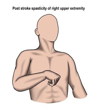 The post stroke spasticity of right arm.