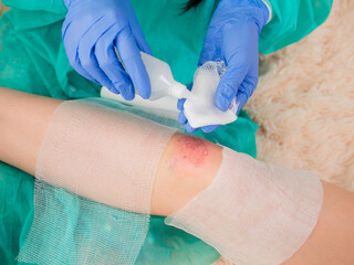 A female doctor treats an antiseptic bandage for dressing a wound on the knee of a teenage girl.