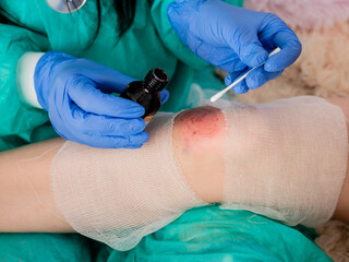 Close-up of the wound on the knee of a teenage girl, which the doctor treats with a cotton swab...