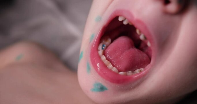 close the mouth of a child with very bad teeth. on the teeth of the child colored fillings. very bad front teeth in a child. on the boy's face acne of chicken pox anointed with green.
