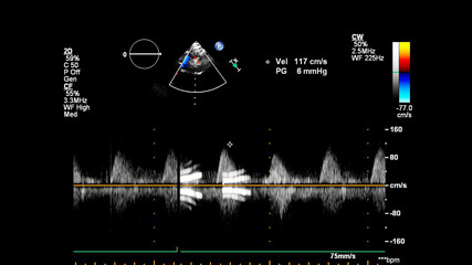 Image of the heart during transesophageal ultrasound with Doppler mode.