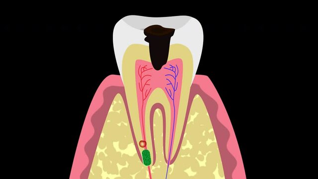 Causes of tooth cysts 4K