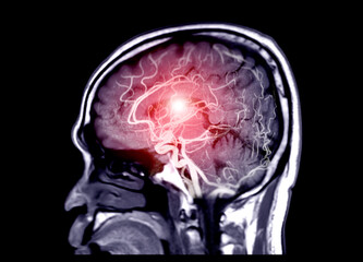 MRA Brain or Magnetic resonance angiography ( MRA )  of cerebral artery in the brain Sagittal view...