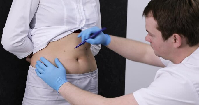 The surgeon marks the abdomen for liposuction