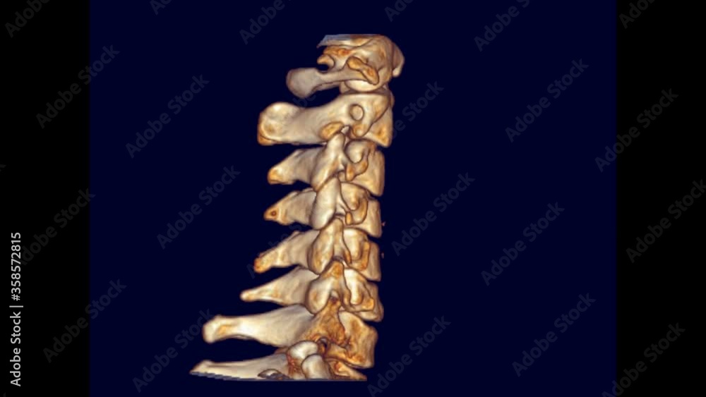 Poster ct c-spine or cervical spine 3d rendering image of patient trauma case turn around on the monitor . 