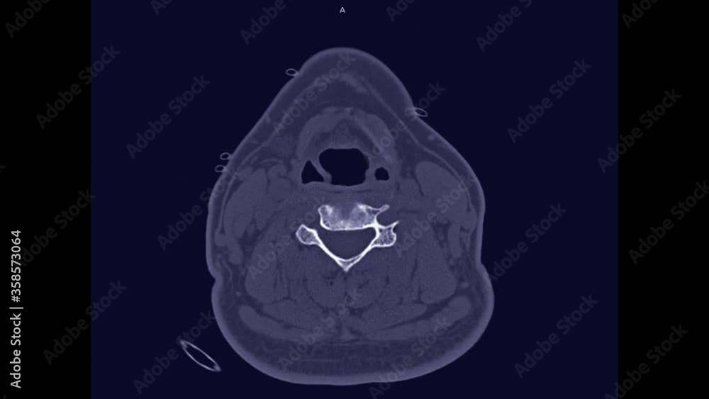 Poster ct c-spine or cervical spine axial view of patient trauma case for detect c-spine fracture.