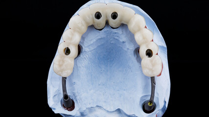 top view of a dental prosthesis of the upper jaw with a beam, shot on a black background © Dental Pro Content