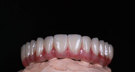 Zirconia prosthesis