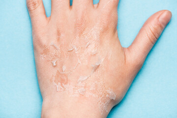 partial view of female hand with dry, exfoliated skin on blue