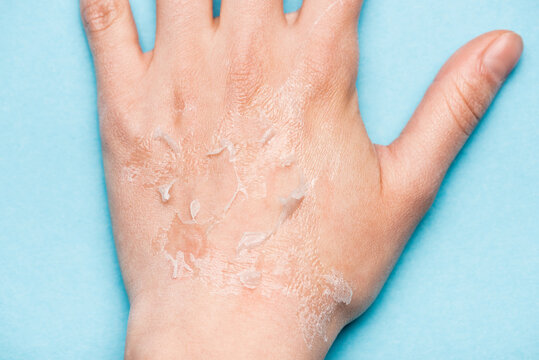 Partial View Of Female Hand With Dry, Exfoliated Skin On Blue