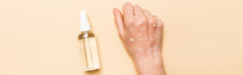 panoramic shot of female hand with dry, exfoliated skin near antiseptic spray on beige