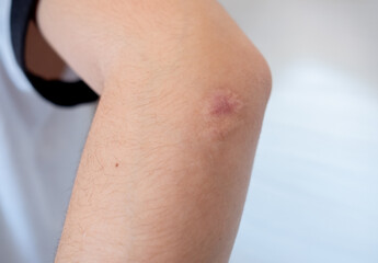 close-up scar on a woman's elbow on a white background