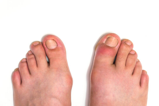 Gout or podagra on the big toe appears as redness and a unbearable pain