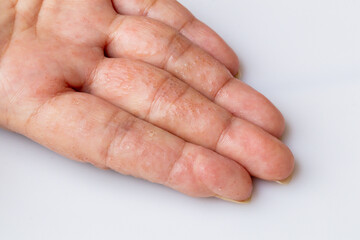 Close up Atopic dermatitis on finger(AD), also known as Atopic eczema.Skin disease concept.