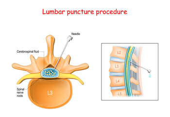 Lumbar puncture procedure.
