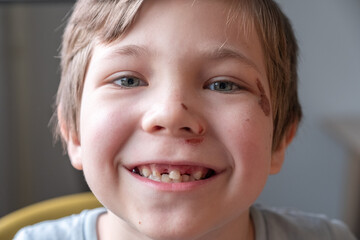 Toothless kid smiling. Little boy Show Broken teeth