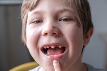 Toothless kid smiling. Little boy Show Broken teeth