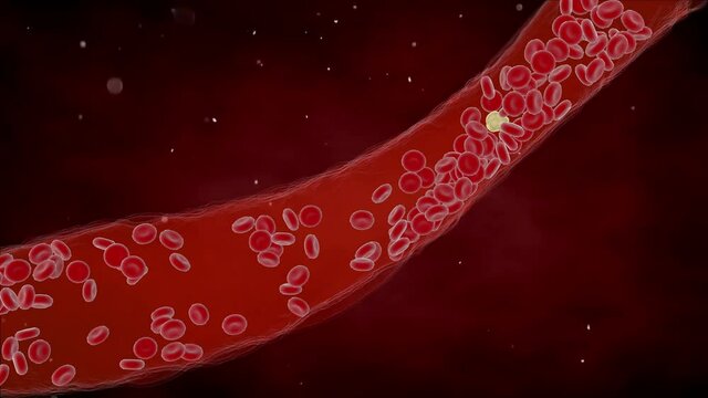 Clogged Artery with platelets and cholesterol plaque, concept for health risk for obesity or dieting and nutrition problems
