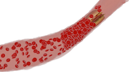 Clogged Artery with platelets and cholesterol plaque, concept for health risk for obesity