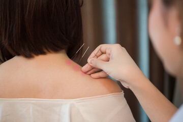 Acupuncture.Close-up Of A Person Getting An Acupuncture Treatment